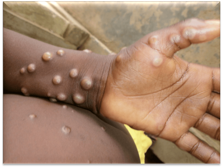 Photo credit: Nigeria Centre for Disease Control